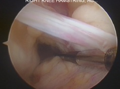 Anterior cruciate ligament reconstruction - City Hospital, Dehradun