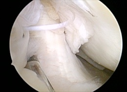 Anterior cruciate ligament reconstruction - City Hospital, Dehradun