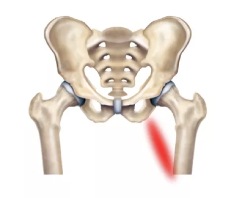 Adductor Tendinopathy City Hospital Dehradun