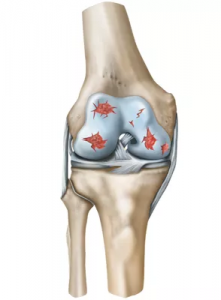 Medial ligament injury - City Hospital, Dehradun